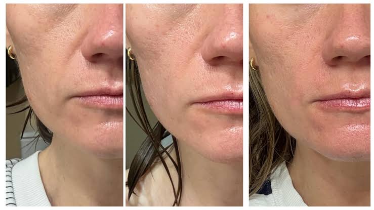 What To Expect with Volufiline